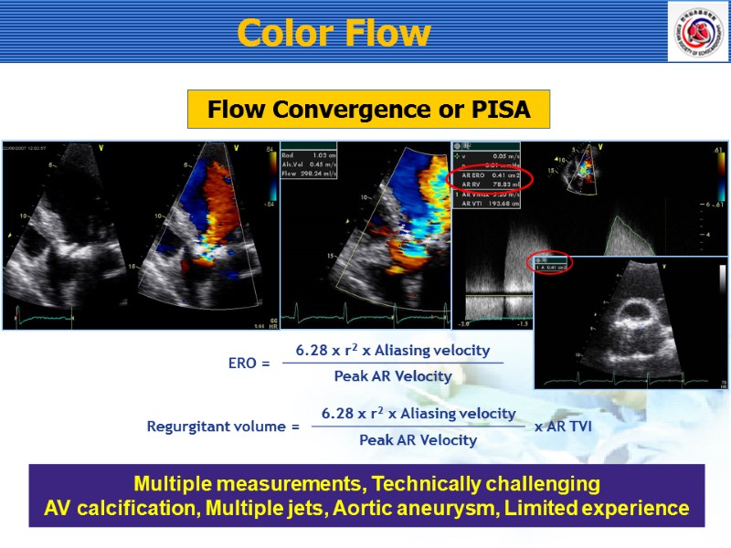Color Flow Flow Convergence or PISA Multiple measurements, Technically challenging AV calcification, Multiple jets,